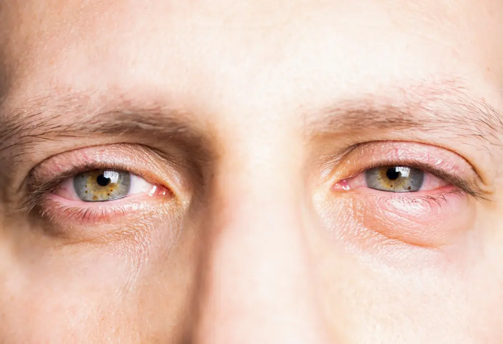 Ausschnitt eines Gesichts eines Mannes, der von gereizten Augen betroffen ist.
