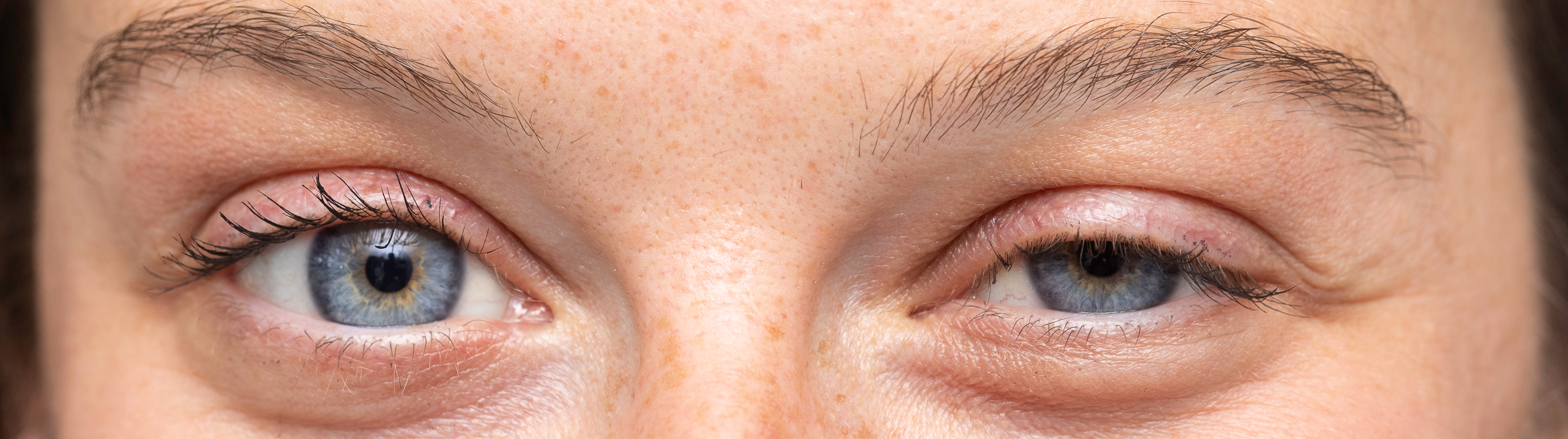 Ausschnitt eines Gesichts einer Frau, die ein geschwollenes Augenlid hat. 