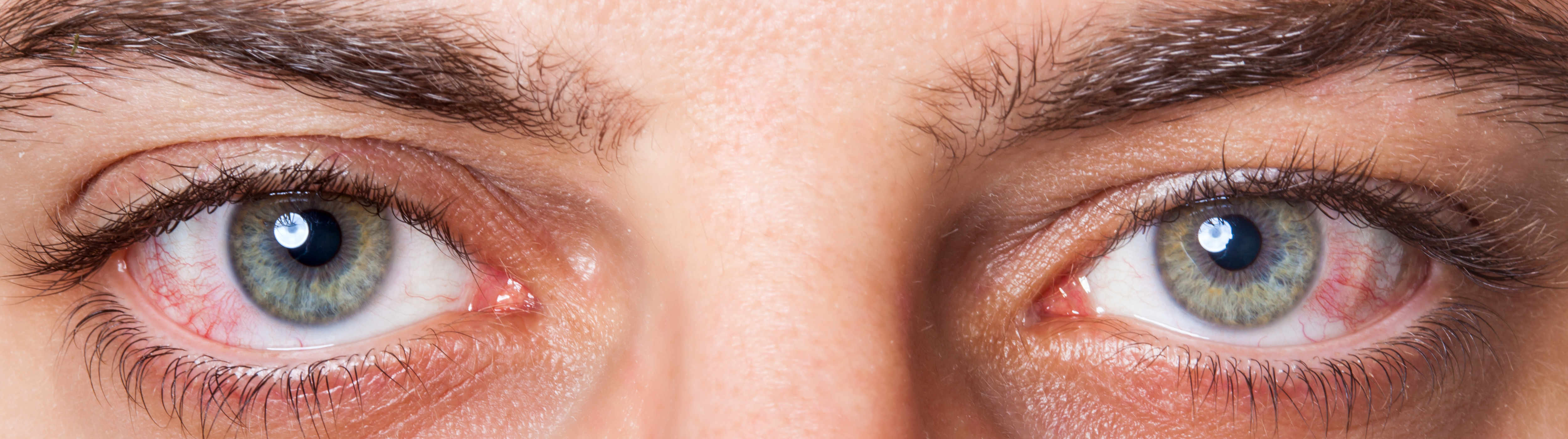 Ausschnitt eines Gesichts eines Mannes: Er hat rote Augen.